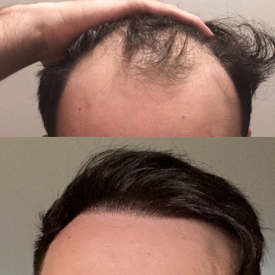 How Does Hair Restoration Work in Dubai