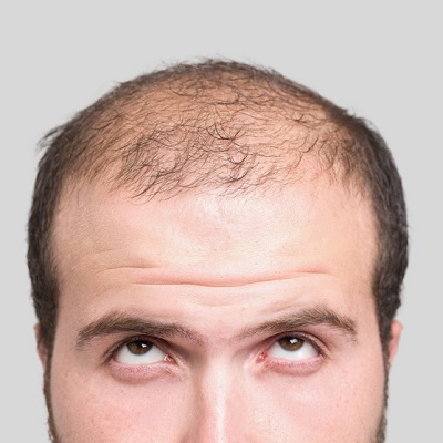 How much is a Hair Transplant in Dubai