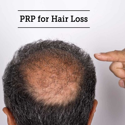 Is PRP Effective for Hair Loss?
