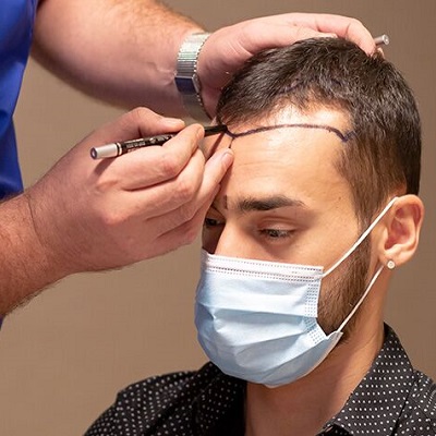 What is the Success Rate of a Hair Transplant in Dubai
