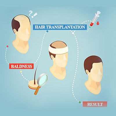Do's And Dont's After Hair Transplant Surgery